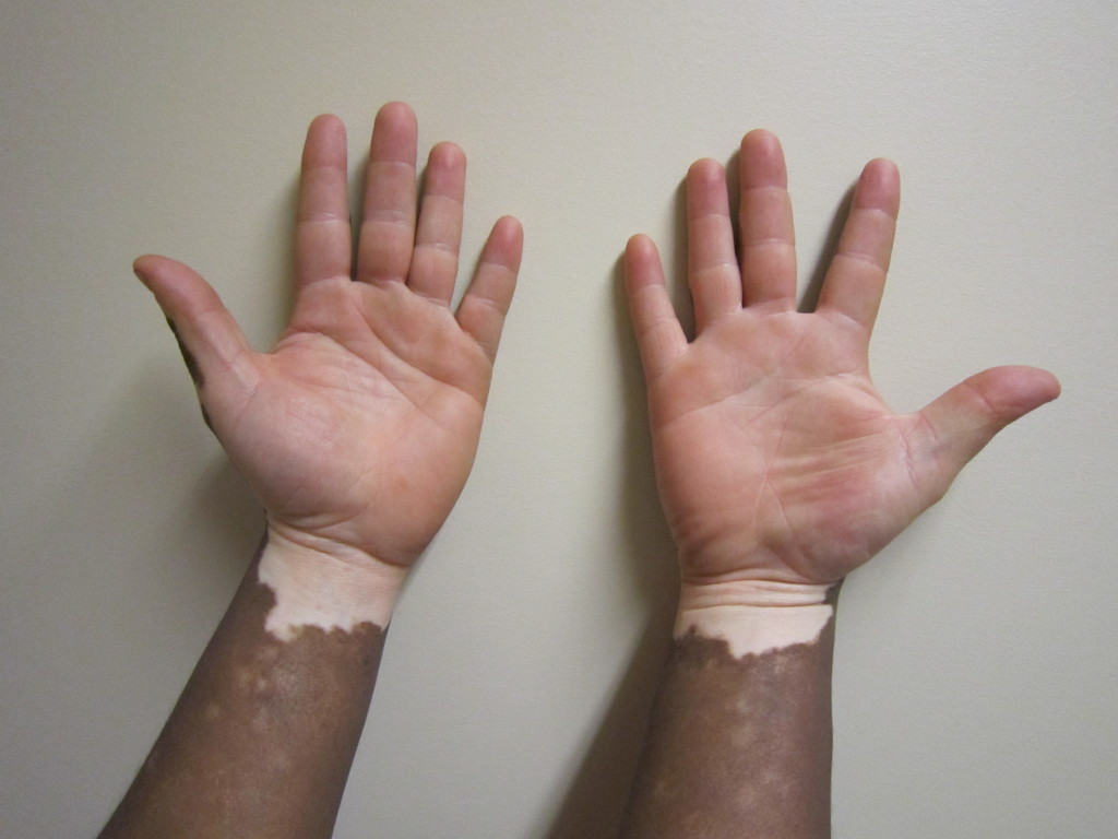 Vitiligo1